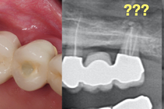 sinus-perforation-after-tooth-extraction-foundation-bone-graft-PRF-kazemi-oral-surgery-05