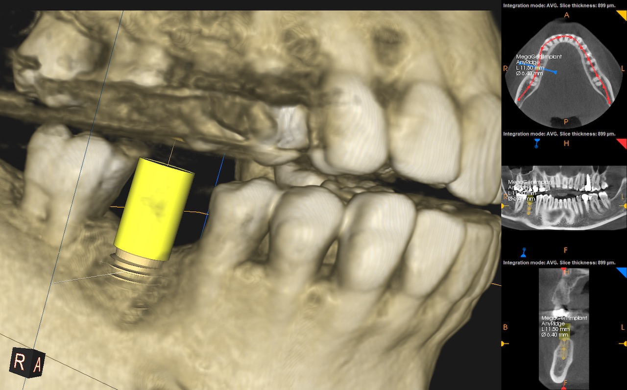 3.-CBCT-Missing-molar-with-thin-bone-and-gum-tissue-planned-for-bone-graft-for-dental-implant-kazemi-oral-surgery-bethesda