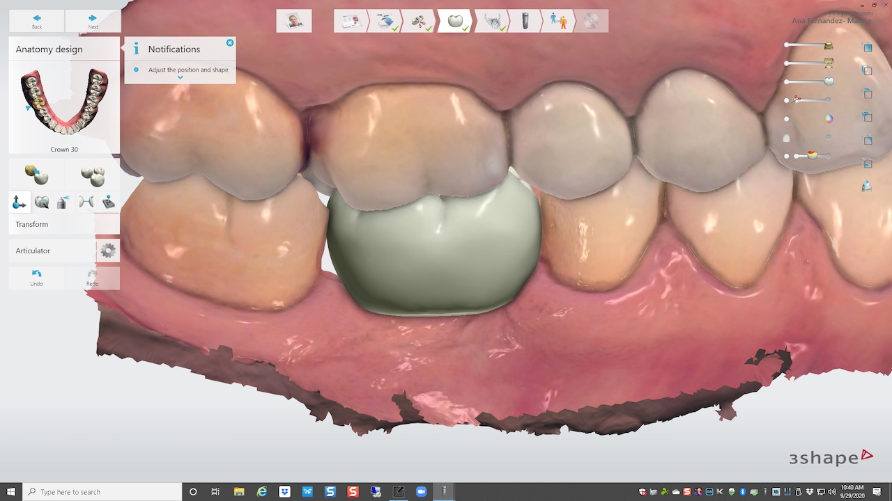 4.-digital-implant-dentistry-for-Missing-molar-with-thin-bone-and-gum-tissue-planned-for-bone-graft-for-dental-implant-kazemi-oral-surgery-bethesda