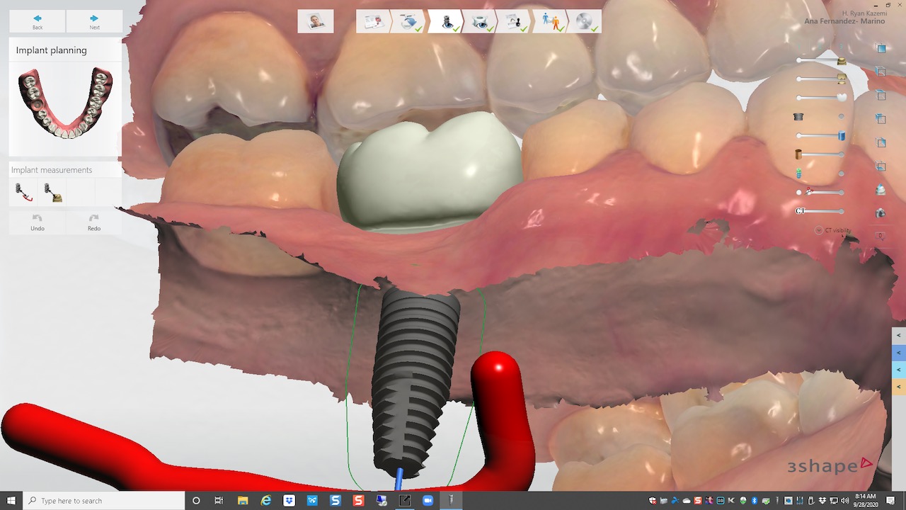 5.-digital-implant-dentistry-for-Missing-molar-with-thin-bone-and-gum-tissue-planned-for-bone-graft-for-dental-implant-kazemi-oral-surgery-bethesda