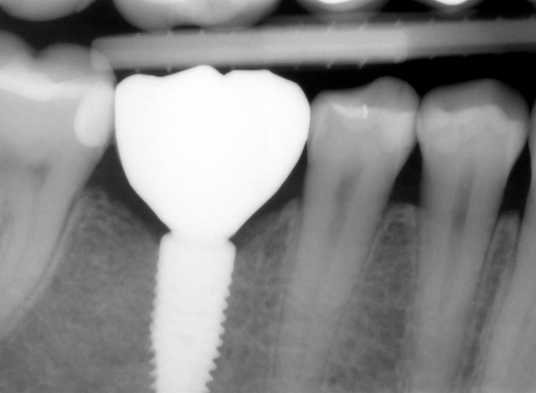 8.-Final-implant-crown-xray-for-Missing-molar-with-thin-bone-and-gum-tissue-planned-for-bone-graft-for-dental-implant-kazemi-oral-surgery-bethesda