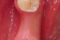 1.-Missing-molar-with-thin-bone-and-gum-tissue-planned-for-bone-graft-for-dental-implant-kazemi-oral-surgery-bethesda