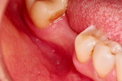 2.-Missing-molar-with-thin-bone-and-gum-tissue-planned-for-bone-graft-for-dental-implant-kazemi-oral-surgery-bethesda