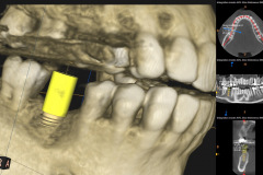 3.-CBCT-Missing-molar-with-thin-bone-and-gum-tissue-planned-for-bone-graft-for-dental-implant-kazemi-oral-surgery-bethesda
