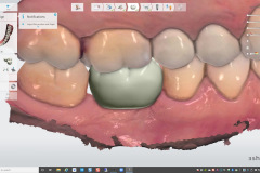4.-digital-implant-dentistry-for-Missing-molar-with-thin-bone-and-gum-tissue-planned-for-bone-graft-for-dental-implant-kazemi-oral-surgery-bethesda