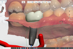 5.-digital-implant-dentistry-for-Missing-molar-with-thin-bone-and-gum-tissue-planned-for-bone-graft-for-dental-implant-kazemi-oral-surgery-bethesda
