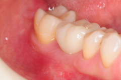 6.-Final-implant-crown-for-Missing-molar-with-thin-bone-and-gum-tissue-planned-for-bone-graft-for-dental-implant-kazemi-oral-surgery-bethesda