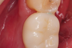 7.-Final-implant-crown-for-Missing-molar-with-thin-bone-and-gum-tissue-planned-for-bone-graft-for-dental-implant-kazemi-oral-surgery-bethesda