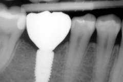 8.-Final-implant-crown-xray-for-Missing-molar-with-thin-bone-and-gum-tissue-planned-for-bone-graft-for-dental-implant-kazemi-oral-surgery-bethesda