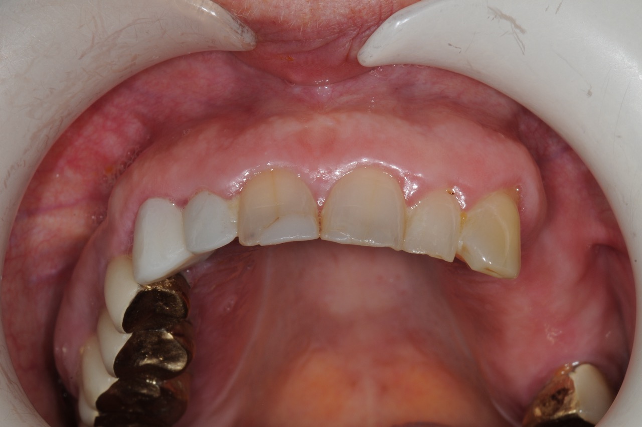 2.-Full-arch-pink-free-dental-implants-smile-design-bethesda-dentist