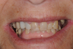 1.-Full-arch-pink-free-dental-implants-smile-design-bethesda-dentist