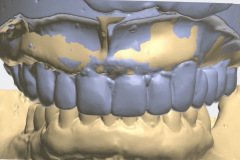 3.-Full-arch-pink-free-dental-implants-smile-design-bethesda-dentist-digital-workflow