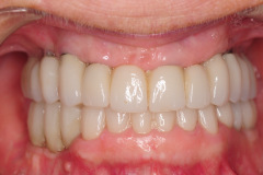 5.-Full-arch-pink-free-dental-implants-smile-design-bethesda-dentist