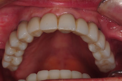 6.-Full-arch-pink-free-dental-implants-smile-design-bethesda-dentist