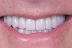 7.-Full-arch-pink-free-dental-implants-smile-design-bethesda-dentist