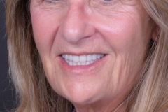 8.-Full-arch-pink-free-dental-implants-smile-design-bethesda-dentist
