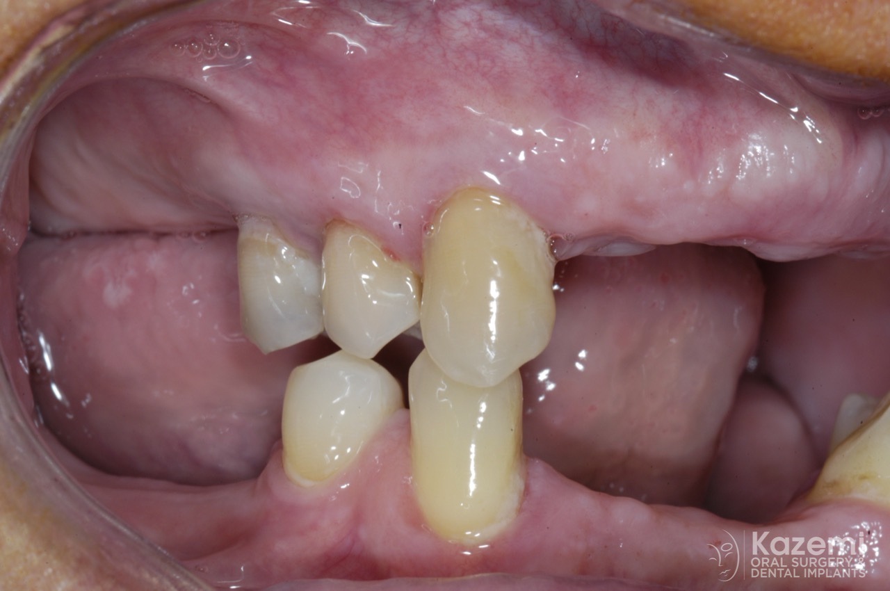 full-arch-multiple-implants-for-bridge-kazemi-oral-surgery-bethesda-washington-dc-2