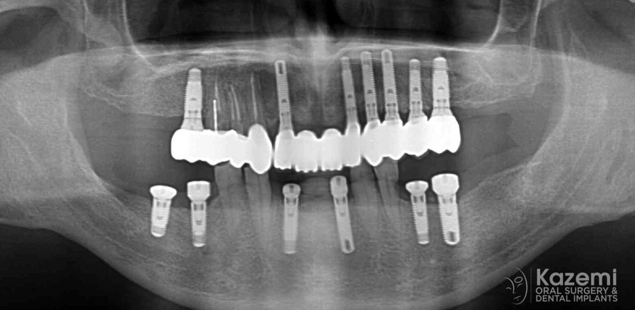 full-arch-multiple-implants-for-bridge-kazemi-oral-surgery-bethesda-washington-dc-6