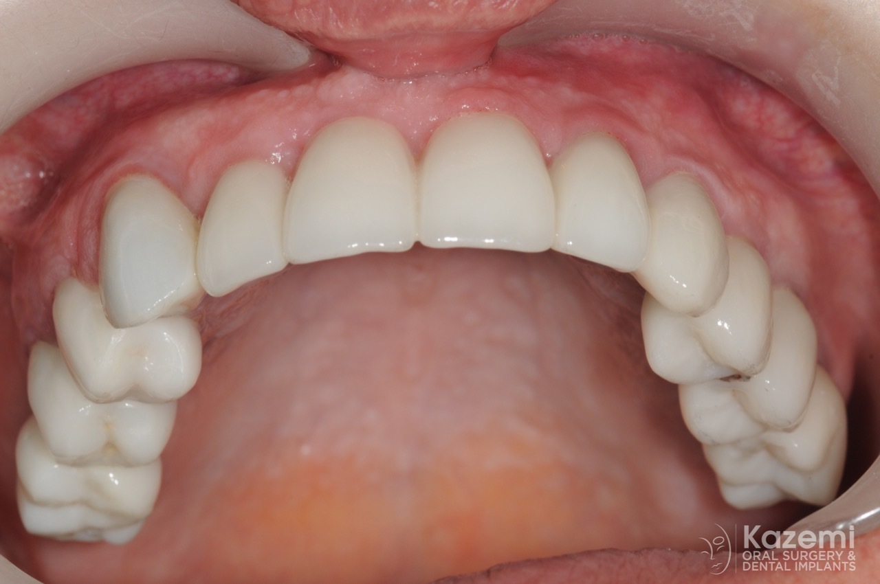 full-arch-multiple-implants-for-bridge-kazemi-oral-surgery-bethesda-washington-dc-7