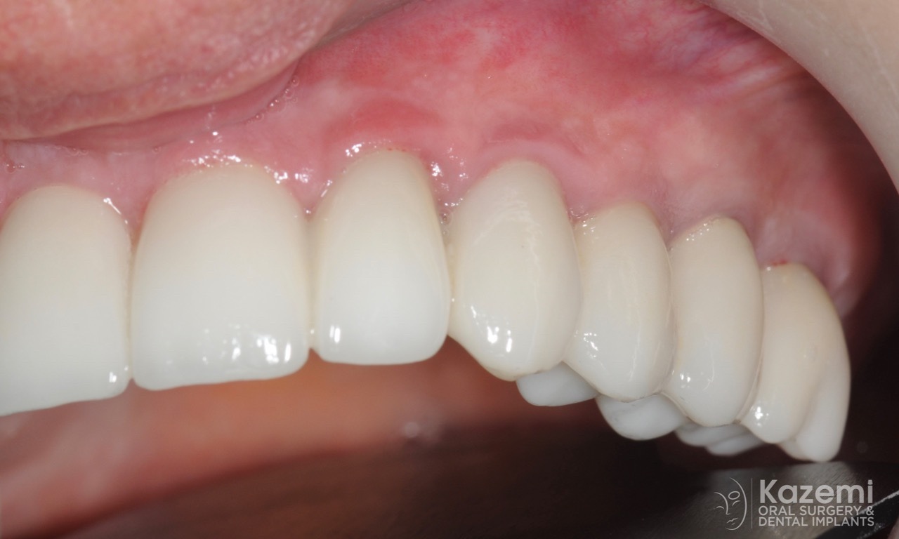 full-arch-multiple-implants-for-bridge-kazemi-oral-surgery-bethesda-washington-dc-9