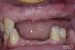 full-arch-multiple-implants-for-bridge-kazemi-oral-surgery-bethesda-washington-dc-1