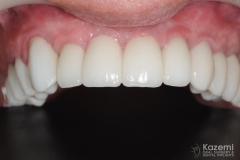 full-arch-multiple-implants-for-bridge-kazemi-oral-surgery-bethesda-washington-dc-10