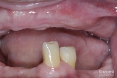 full-arch-multiple-implants-for-bridge-kazemi-oral-surgery-bethesda-washington-dc-3