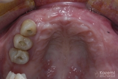 full-arch-multiple-implants-for-bridge-kazemi-oral-surgery-bethesda-washington-dc-4