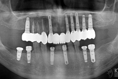 full-arch-multiple-implants-for-bridge-kazemi-oral-surgery-bethesda-washington-dc-6