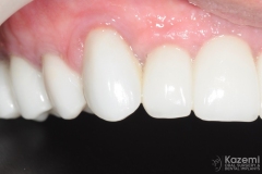 full-arch-multiple-implants-for-bridge-kazemi-oral-surgery-bethesda-washington-dc-8