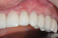 full-arch-multiple-implants-for-bridge-kazemi-oral-surgery-bethesda-washington-dc-9