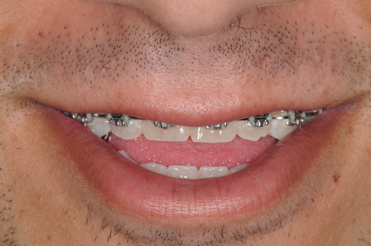 2. jaw surgery orthognathic kazemi oral surgery #2