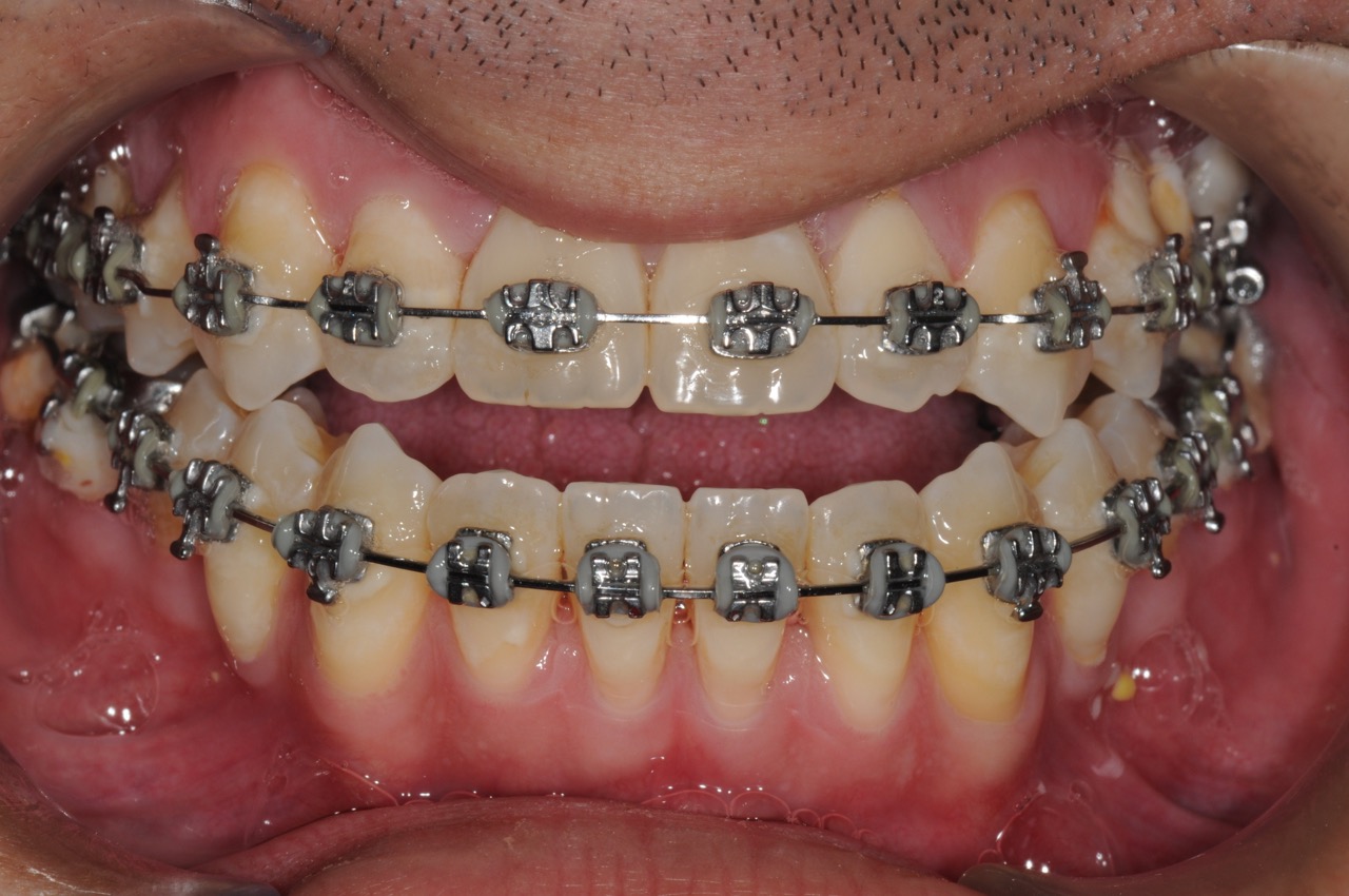 3. jaw surgery orthognathic kazemi oral surgery #3