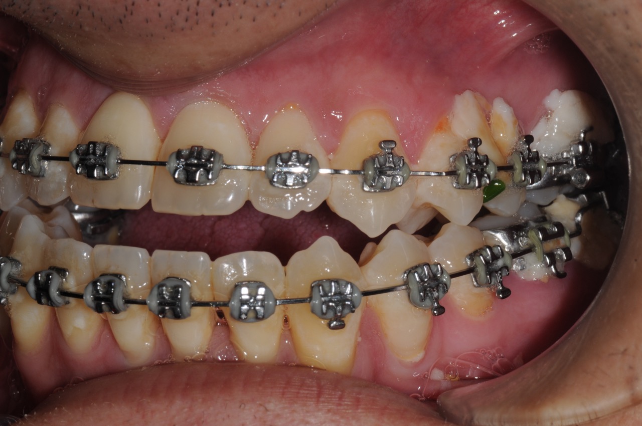 4. jaw surgery orthognathic kazemi oral surgery #4