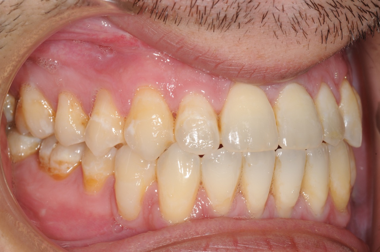 6. jaw surgery orthognathic kazemi oral surgery #6