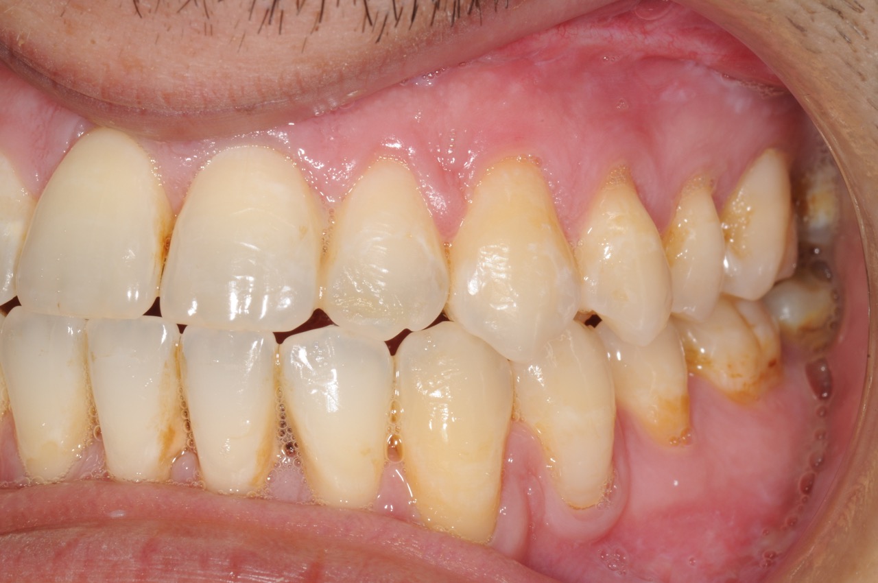 7. jaw surgery orthognathic kazemi oral surgery #7