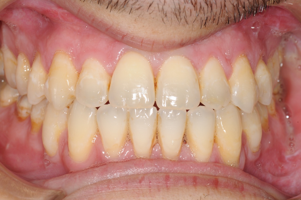 8. jaw surgery orthognathic kazemi oral surgery #8