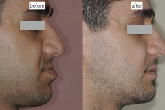 10. jaw surgery orthognathic kazemi oral surgery #10