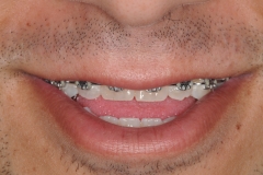 2. jaw surgery orthognathic kazemi oral surgery #2
