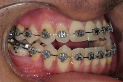 5. jaw surgery orthognathic kazemi oral surgery #5