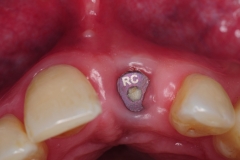 1.-thin-gingival-gum-tissue-over-dental-implant-kazemi-oral-surgery