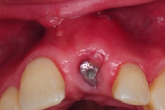 2.-gingival-gum-connective-tissue-graft-over-dental-implant-kazemi-oral-surgery