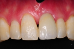 3.-after-gingival-connective-tissue-graft-final-restoration-kazemi-oral-surgery