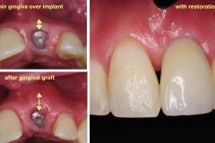 4.-after-gingival-connective-tissue-graft-final-restoration-kazemi-oral-surgery
