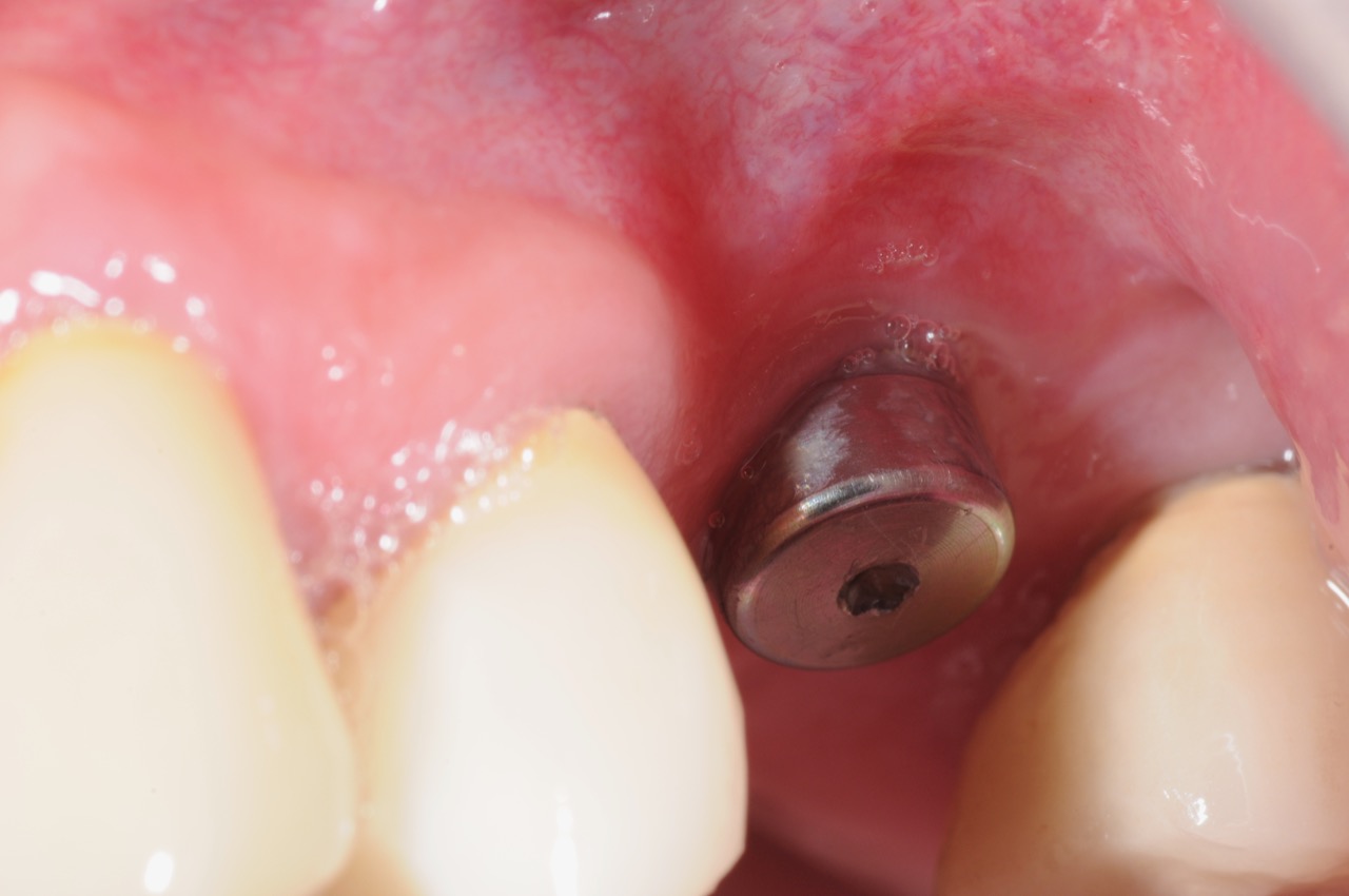 1.-Inadequate-attached-gingival-implant-kazemi-oral-surgery