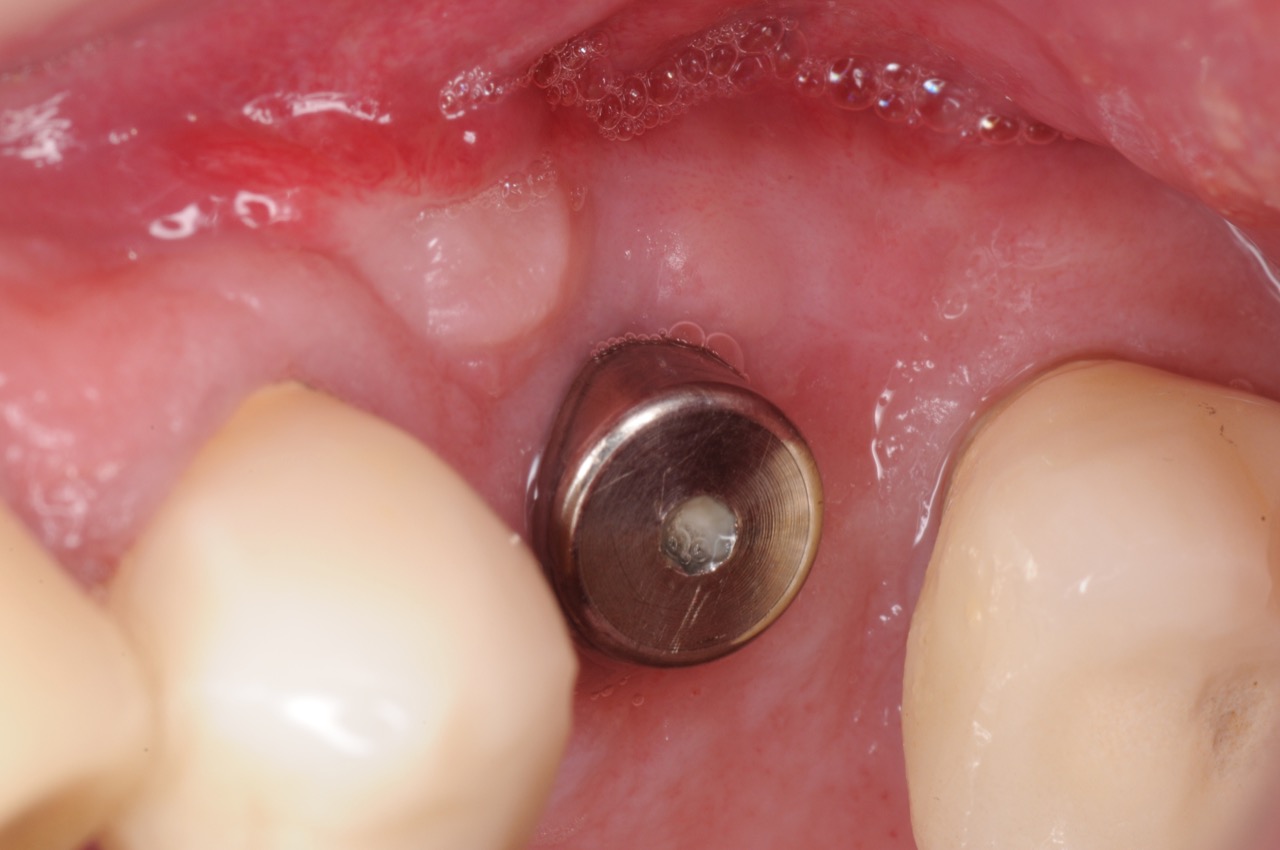 2.-Gum-gingival-graft-for-Inadequate-attached-gingiva-around-implant-kazemi-oral-surgery