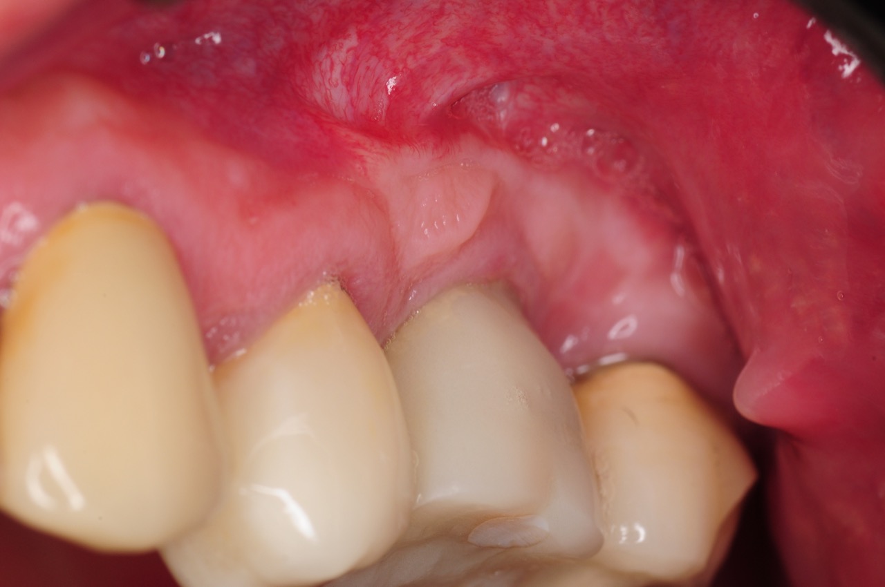 3.-Gum-gingival-graft-for-Inadequate-attached-gingiva-around-final-implant-kazemi-oral-surgery