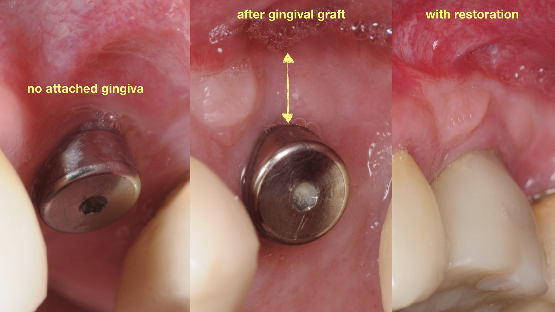 4.-Gum-gingival-graft-for-Inadequate-attached-gingiva-around-final-implant-kazemi-oral-surgery