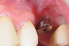1.-Inadequate-attached-gingival-implant-kazemi-oral-surgery