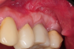 3.-Gum-gingival-graft-for-Inadequate-attached-gingiva-around-final-implant-kazemi-oral-surgery